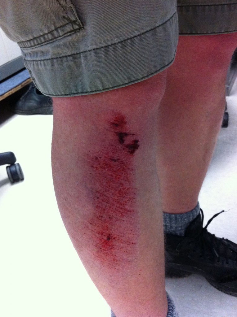 Summer 2011 cycling-induced road rash